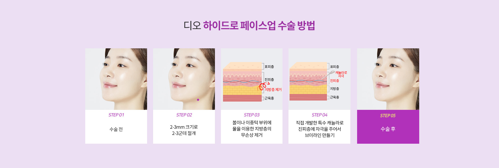 하이드로페이스업수술방법