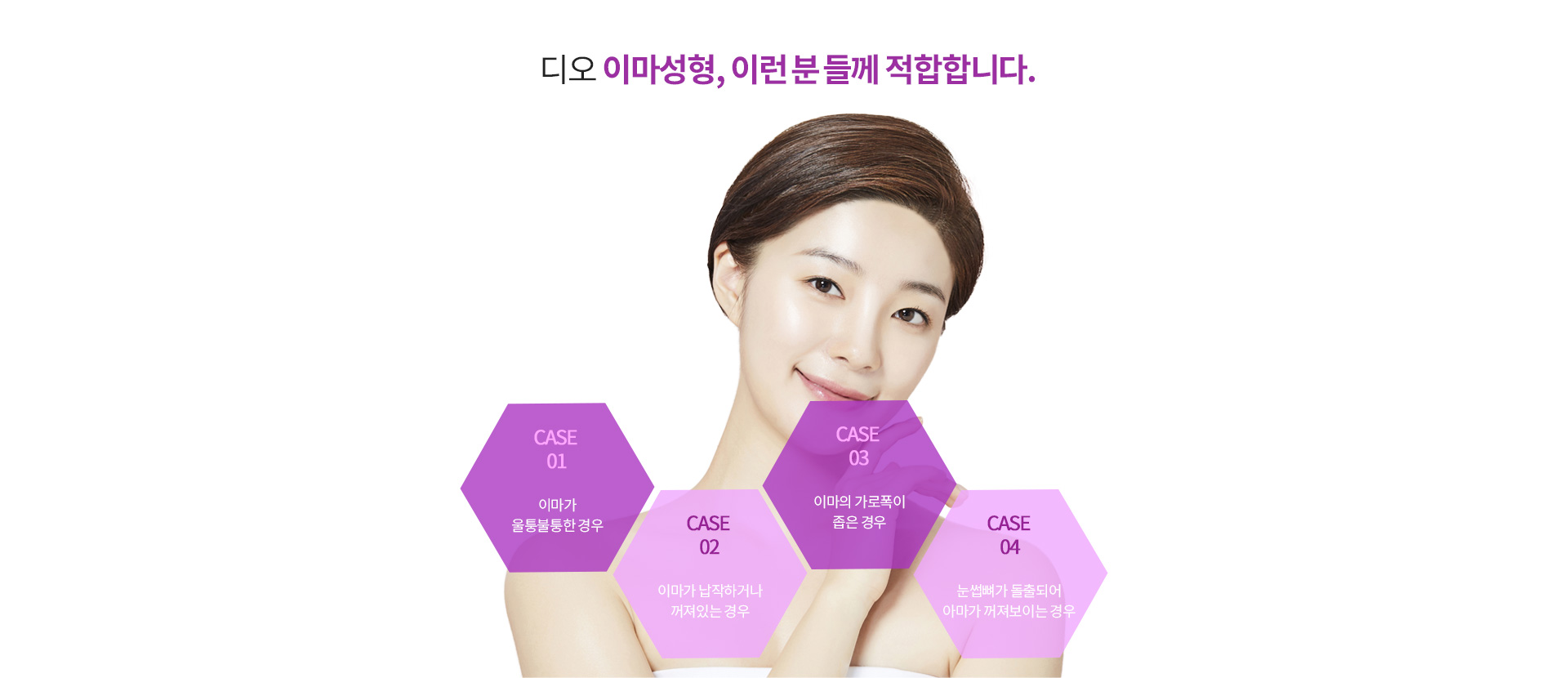 이마성형이  필요한경우