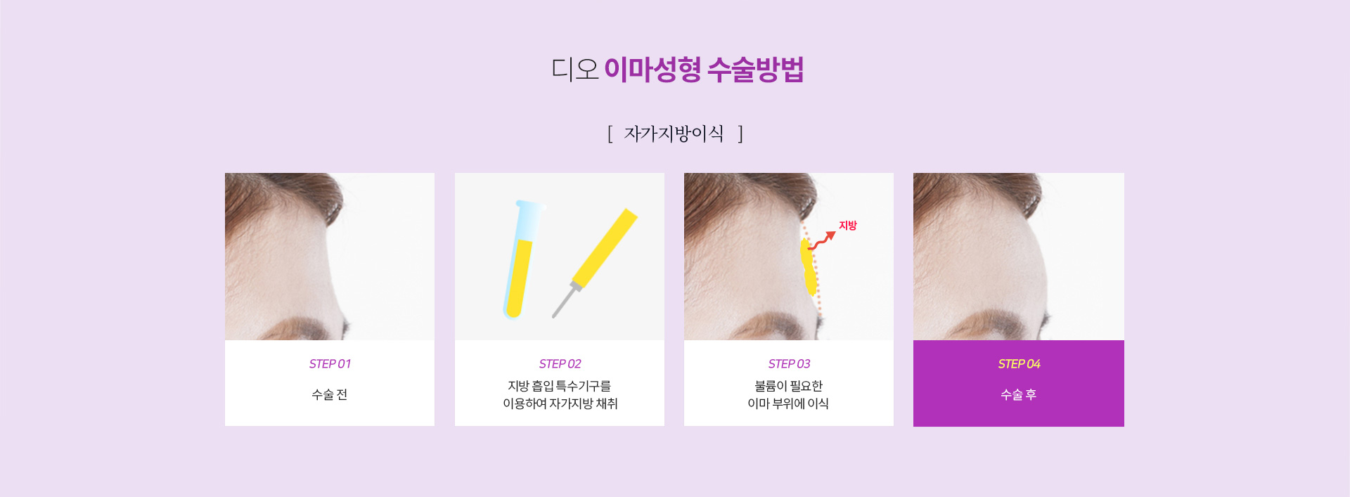 귀족성형수술방법