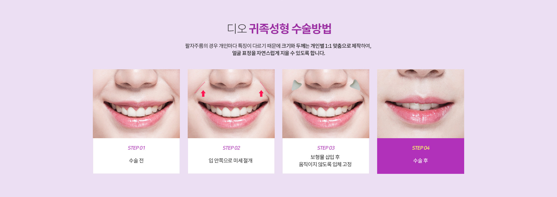 귀족성형수술방법