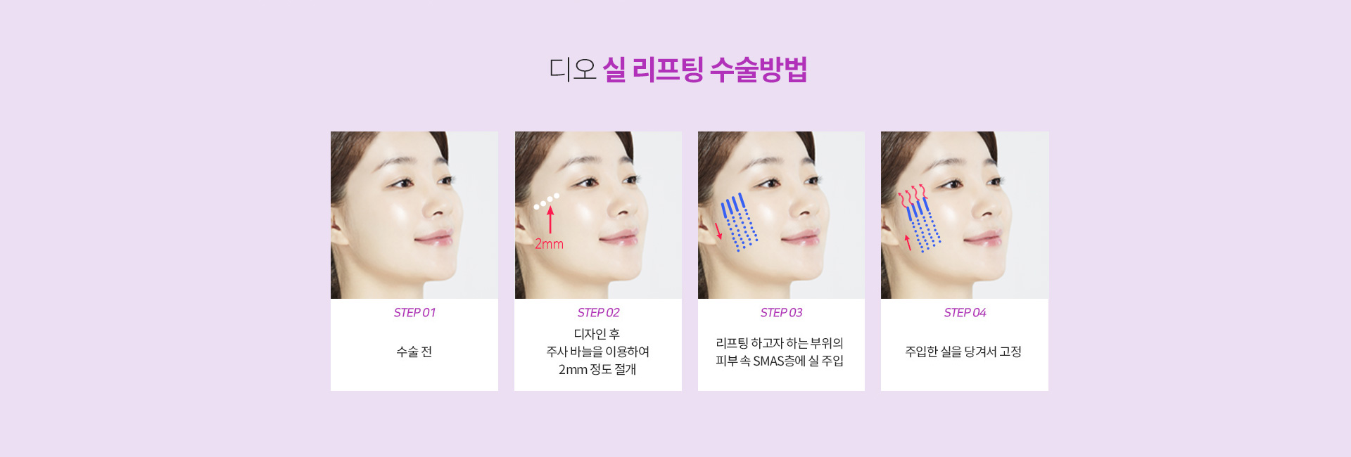 실리프팅 수술방법