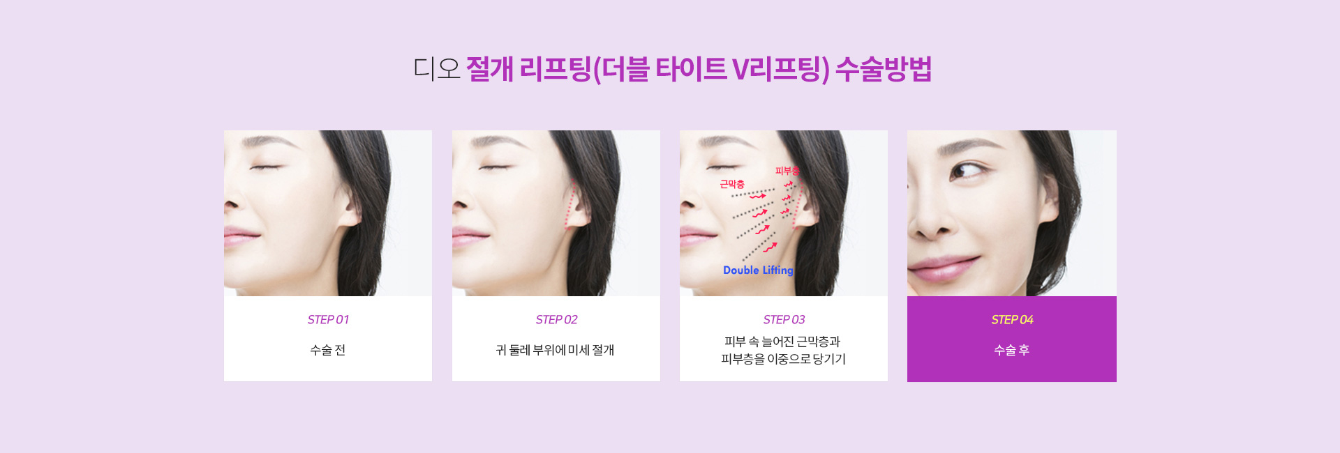 절개리프팅수술방법