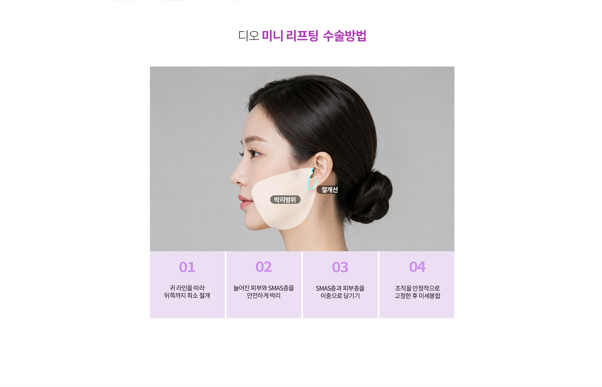 미니리프팅 절개 위치와 SMAS층 박리 및 조직 고정 과정을 단계별로 설명하는 수술 방법 안내 이미지.