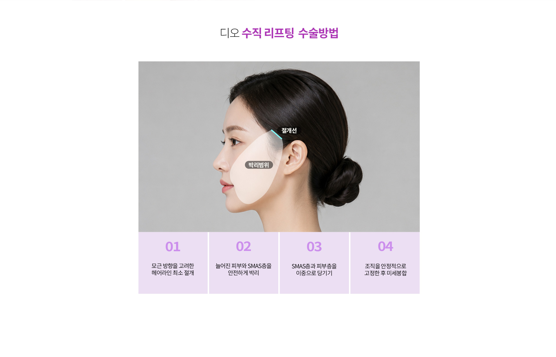 수직리프팅 절개 위치와 SMAS층 박리 및 조직 고정 과정을 단계별로 설명하는 수술 방법 안내 이미지.
