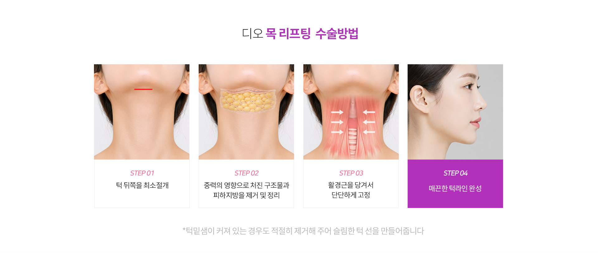 목리프팅 절개 위치와 수술 과정을 단계별로 설명하는 수술 방법 안내 이미지.