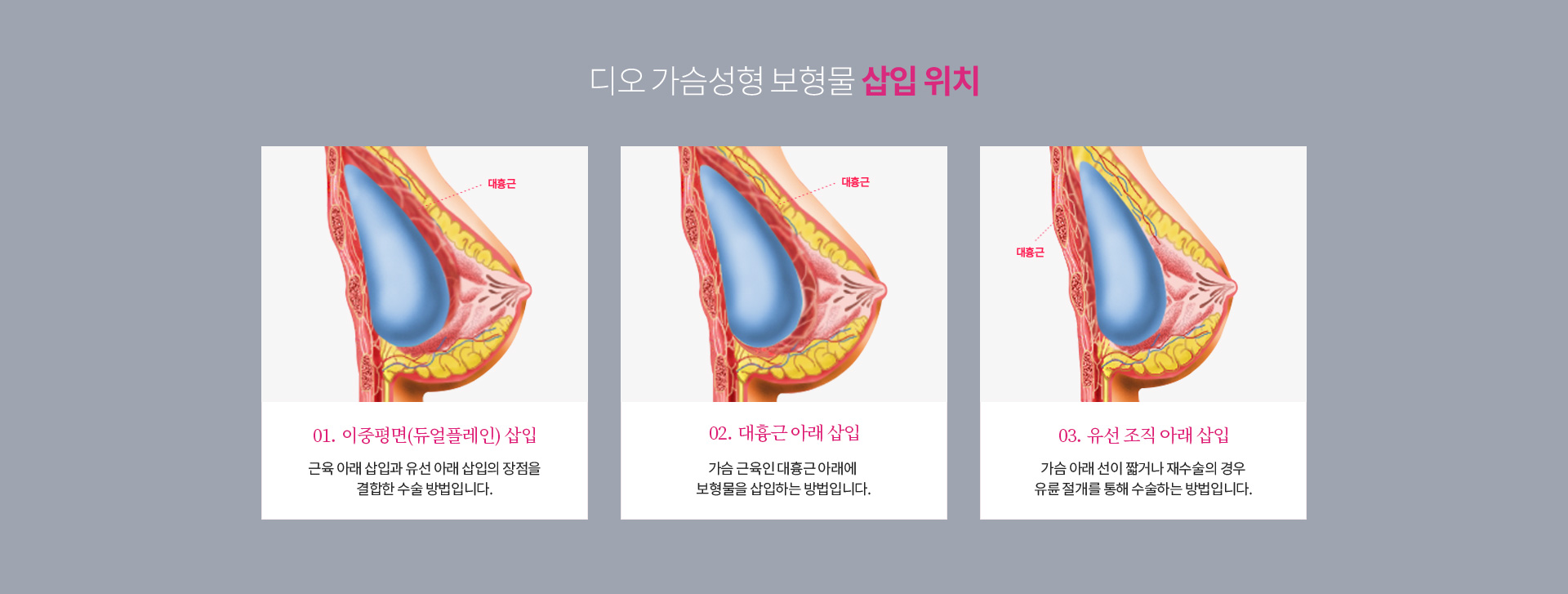 디오 가슴성형 보형물 삽입 위치 — 이중평면(듀얼플레인) 삽입은 근육 아래 삽입과 유선 아래 삽입의 장점을 결합한 방법, 대흉근 아래 삽입, 유선 조직 아래 삽입은 가슴 아래 선이 짧거나 재수술의 경우 유륜 절개를 통해 수술하는 방법