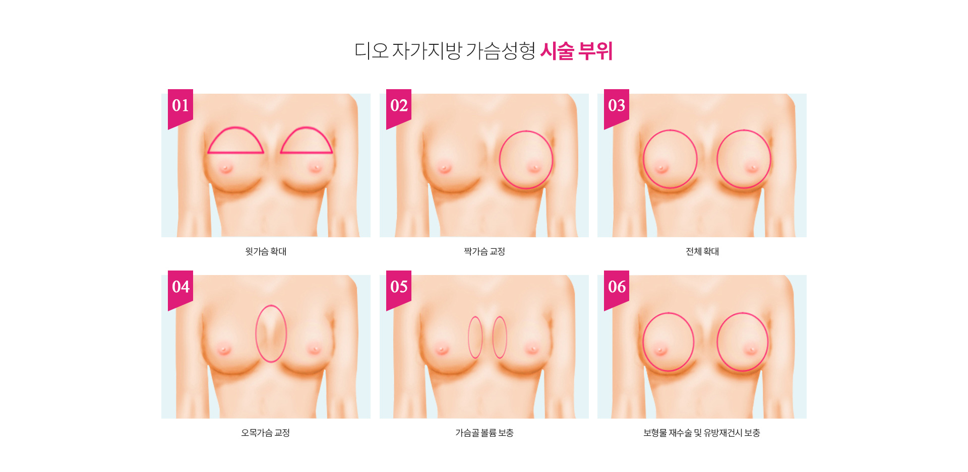 자가지방 가슴성형 시술 부위
