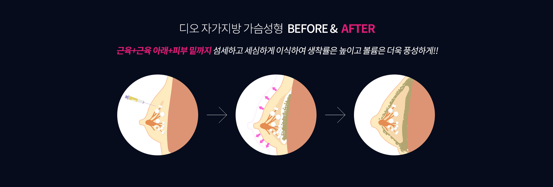 자가지방 가슴성형 후 가슴의 변화