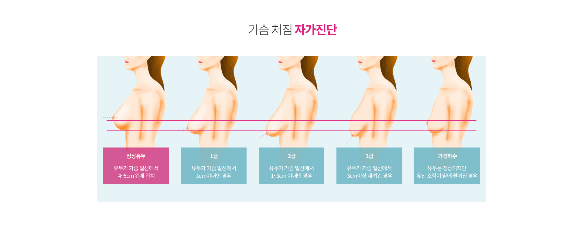 가슴 처짐 자가진단 — 정상유두는 유두가 가슴 밑선에서 4~5cm 위에 위치, 1급은 유두가 가슴 밑선에서 1cm 이내, 2급은 1~3cm 이내, 3급은 3cm 이상 내려간 경우, 가성하수는 유두는 정상이지만 유선 조직이 밑에 떨어진 경우