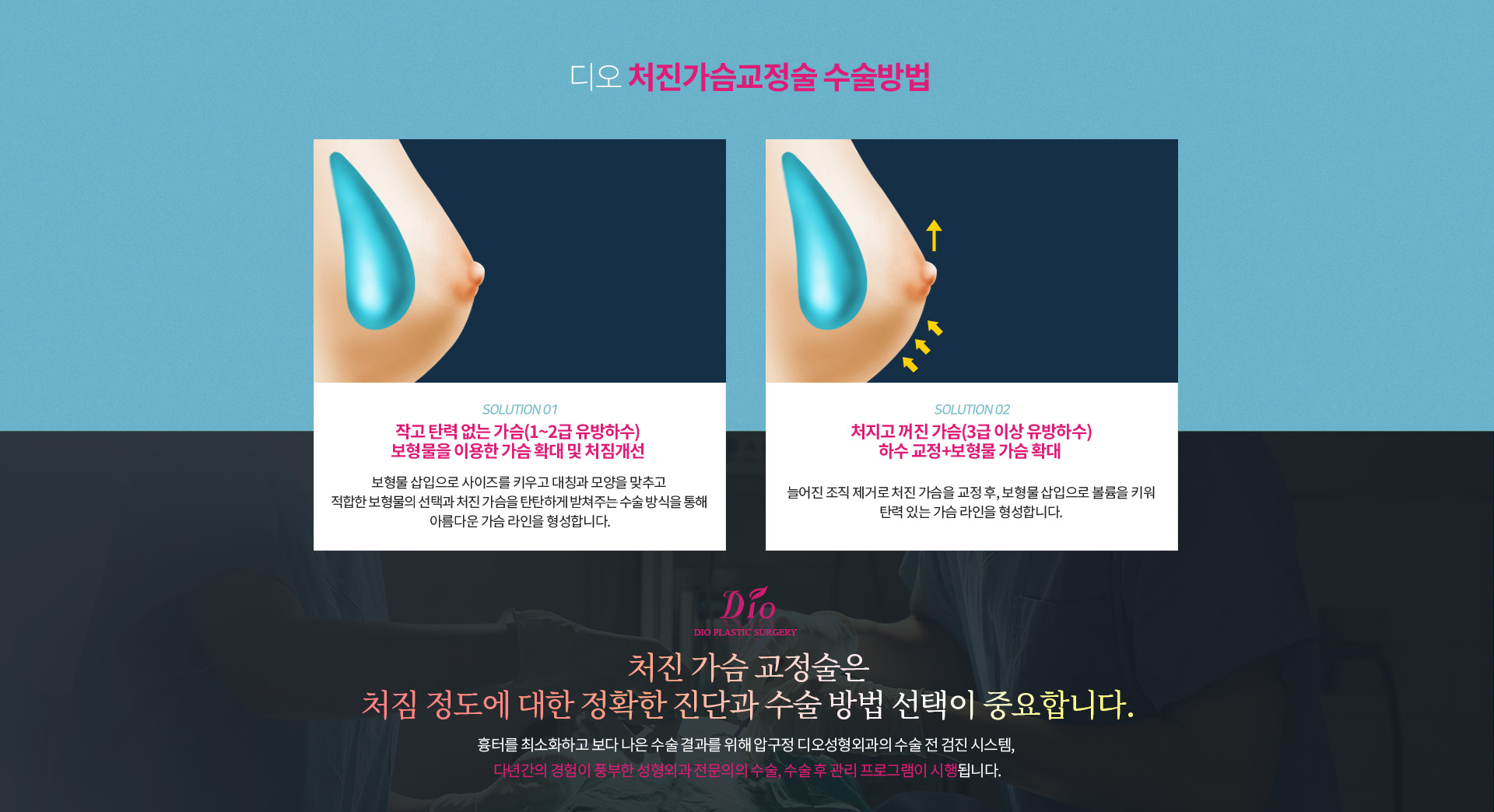 디오 처진가슴교정술 수술방법 — 작고 탄력 없는 가슴(1~2급 유방하수)은 보형물을 이용한 가슴 확대 및 처짐개선, 처지고 꺼진 가슴(3급 이상 유방하수)은 하수 교정과 보형물 가슴 확대를 함께 시행. 처짐 정도에 대한 정확한 진단과 수술 방법 선택이 중요합니다