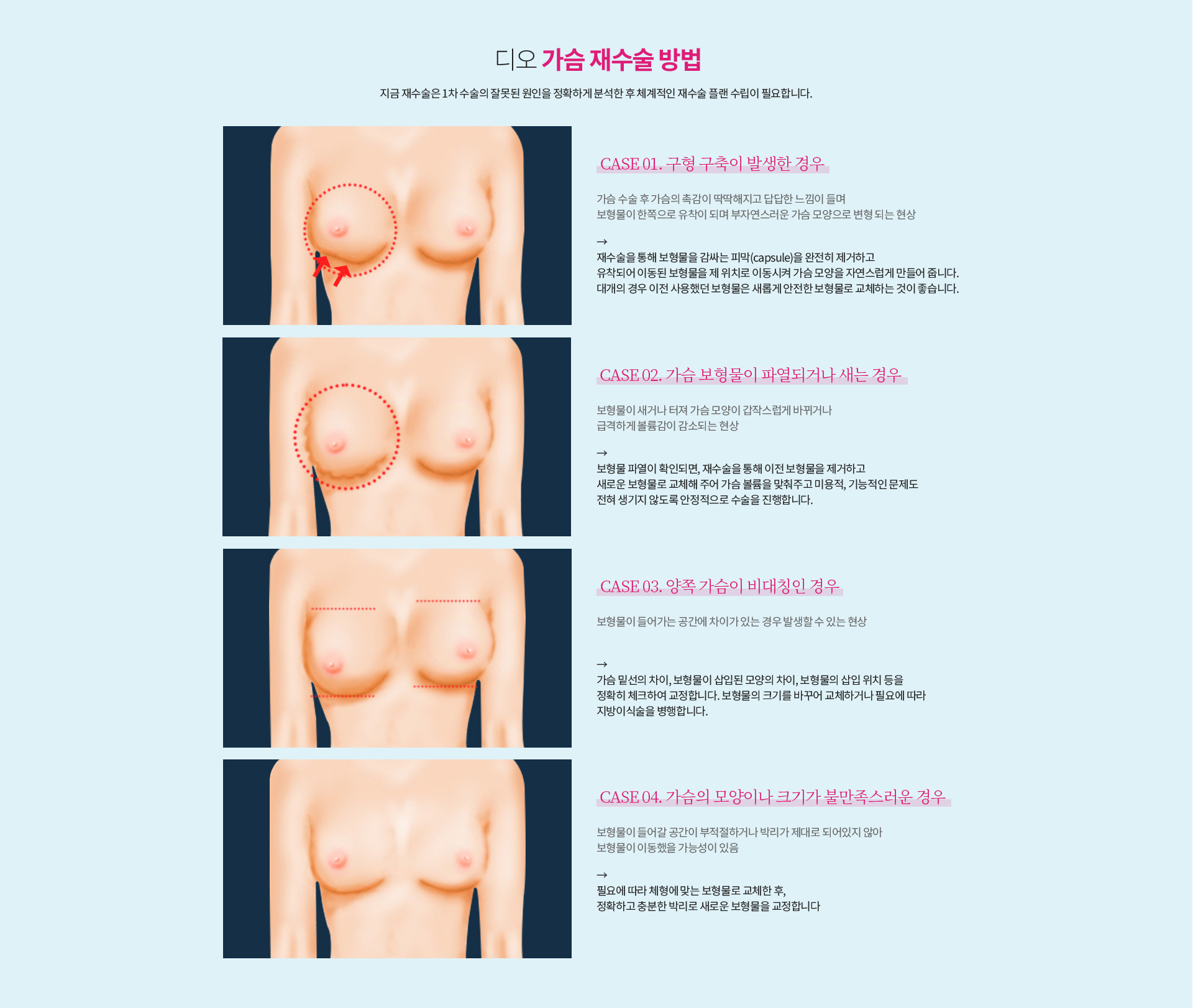 디오 가슴 재수술 방법 — 구형 구축이 발생한 경우 보형물을 감싸는 막을 제거하고 유착·이동된 보형물을 제 위치로 이동, 보형물이 파열되거나 새는 경우 이전 보형물을 제거하고 새 보형물로 교체, 양쪽 가슴이 비대칭인 경우 가슴 밑선·삽입 모양·삽입 위치를 체크하여 교정, 가슴의 모양이나 크기가 불만족스러운 경우 체형에 맞는 보형물로 교체 후 박리하여 교정