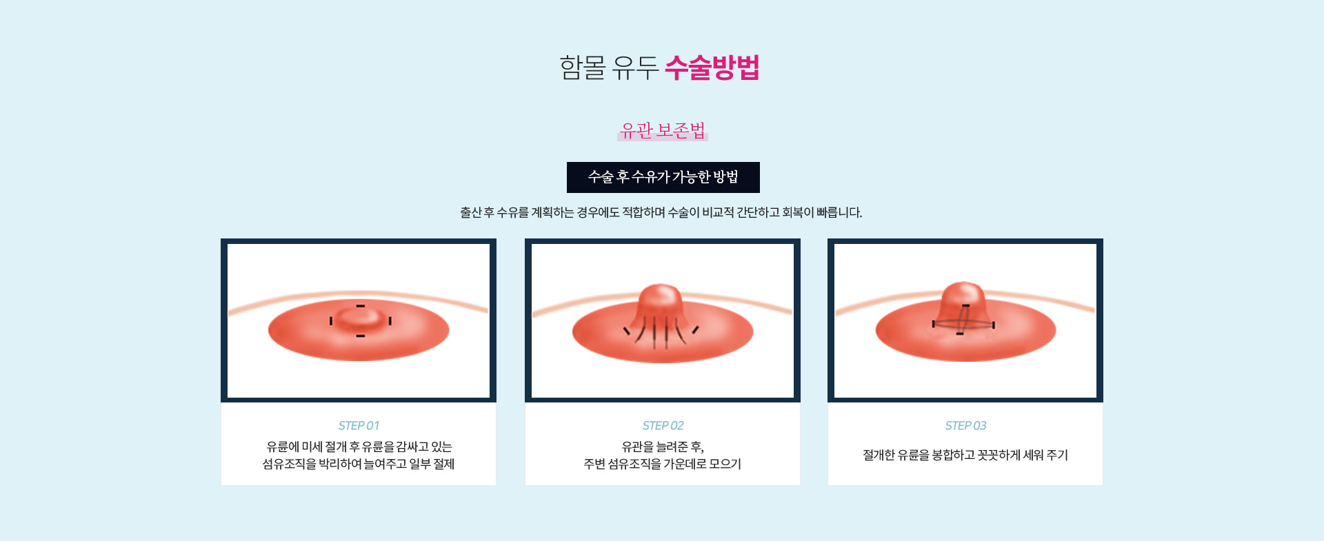 함몰 유두 수술방법(유관 보존법) — 수술 후 수유가 가능한 방법으로 출산 후 수유를 계획하는 경우에도 적합합니다. 유륜에 미세 절개 후 유륜을 감싸고 있는 섬유조직을 박리하여 늘여주고 일부 절제, 유관을 늘려준 후 주변 섬유조직을 가운데로 모으기, 절개한 유륜을 봉합하고 꼿꼿하게 세워 주기