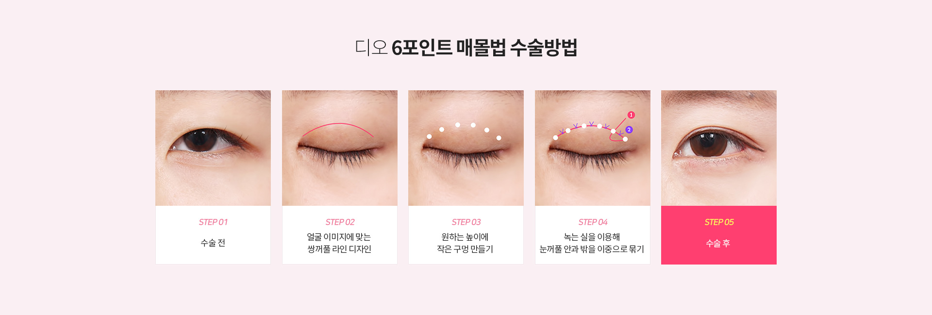 이중매몰법 수술방법