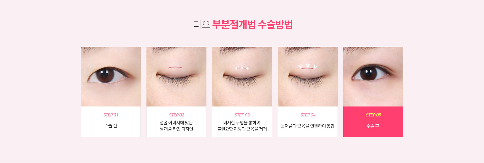 부분절개 수술방법