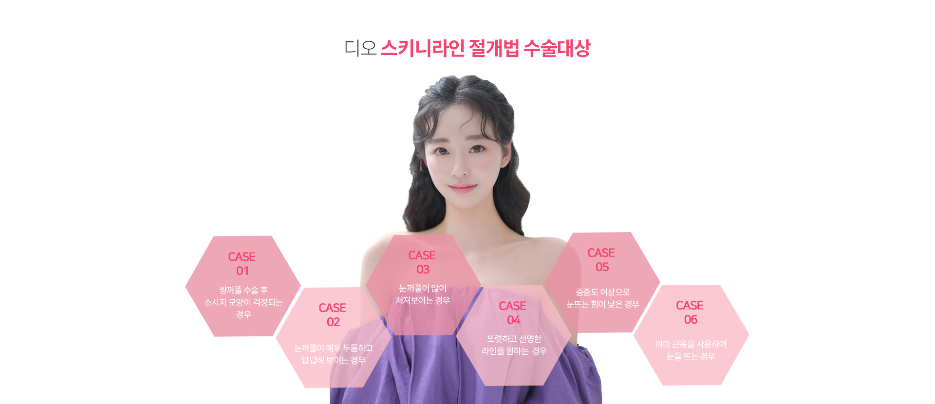 스키니라인절개법이 필요한 경우