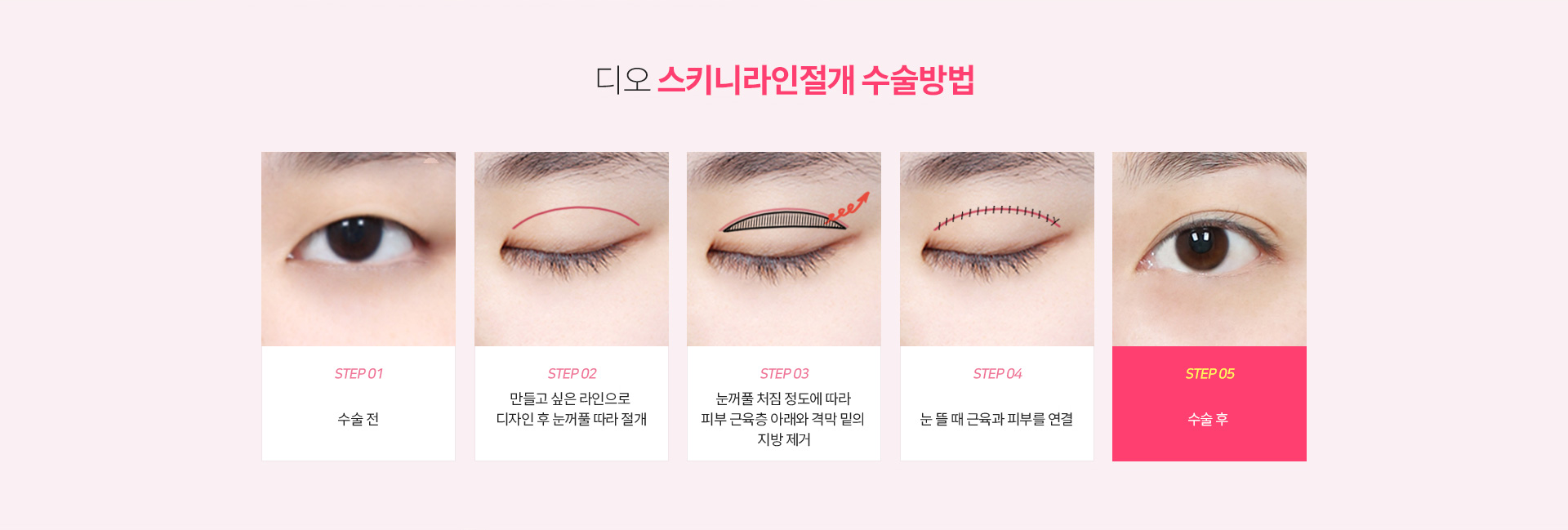 스키니라인절개 수술방법