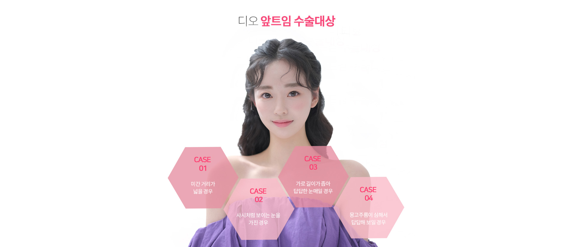 앞트임이 필요한 경우