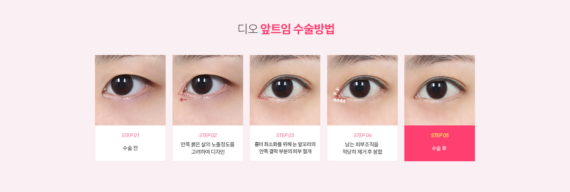 앞트임 수술방법