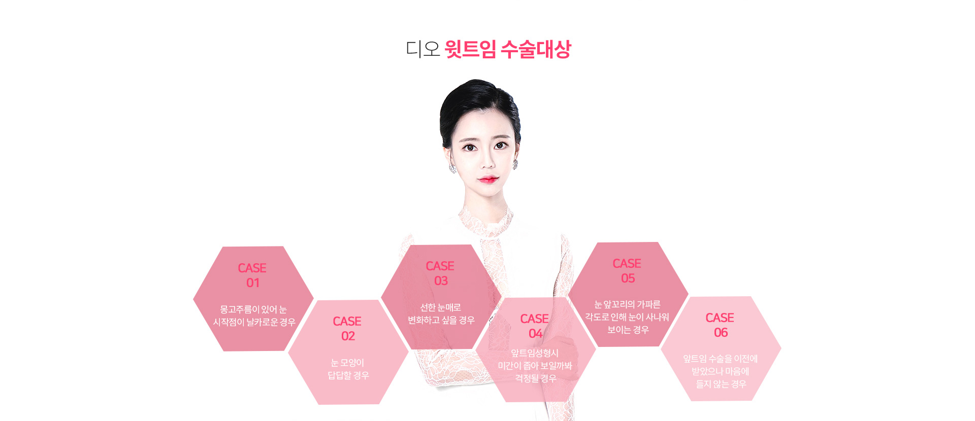 디오 윗트임 수술대상 — 몽고주름으로 눈 시작점이 날카로운 경우, 눈 모양이 답답한 경우, 선한 눈매로 변화하고 싶은 경우, 앞트임 시 미간이 좁아 보일까 걱정되는 경우, 눈앞꼬리 각도로 눈이 사나워 보이는 경우, 앞트임 수술을 받았으나 마음에 들지 않는 경우