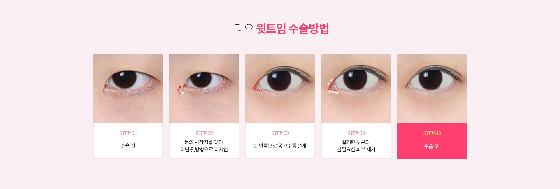 디오 윗트임 수술방법 — 수술 전, 눈 시작점을 윗방향으로 디자인, 눈 안쪽 몽고주름 절개, 절개한 부분의 불필요한 피부 제거, 수술 후