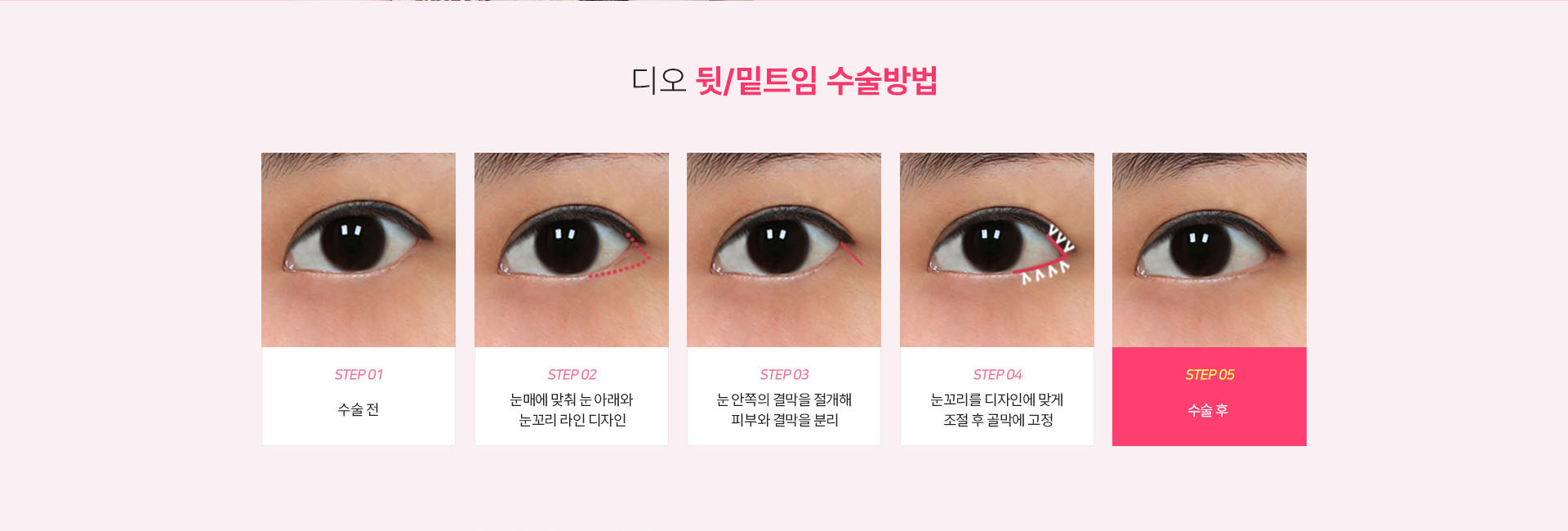 뒷트임 수술방법