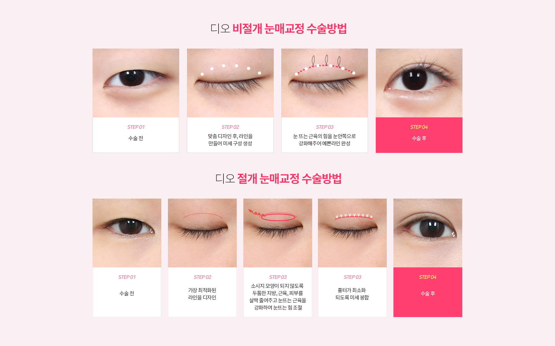 디오 눈매교정 수술방법 — 비절개는 수술 전, 맞춤 디자인 후 라인을 만들어 미세 구성 생성, 눈 뜨는 근육의 힘을 눈안쪽으로 강화, 수술 후. 절개는 수술 전, 최적화된 라인 디자인, 두툼한 지방·근육·피부를 살짝 줄이고 눈뜨는 근육을 강화해 눈뜨는 힘 조절, 흉터가 최소화되도록 미세 봉합, 수술 후