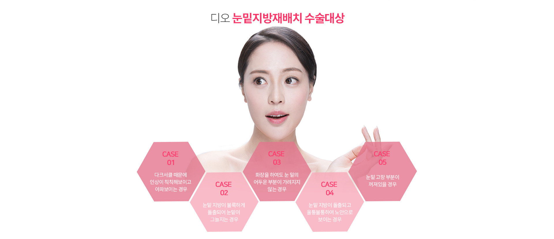 디오 눈밑지방재배치 수술대상 — 다크서클 때문에 인상이 칙칙해 보이는 경우, 눈밑 지방이 볼록하게 돌출되어 눈밑이 그늘지는 경우, 화장을 해도 눈 밑 어두운 부분이 가려지지 않는 경우, 눈밑 지방이 돌출되고 울퉁불퉁하여 노안으로 보이는 경우, 눈밑 고랑 부분이 꺼져 있을 경우