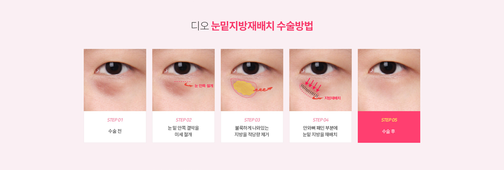 디오 눈밑지방재배치 수술방법 — 수술 전, 눈밑 안쪽 결막을 미세 절개, 볼록하게 나와 있는 지방을 적당량 제거, 안와뼈 패인 부분에 눈밑 지방을 재배치, 수술 후