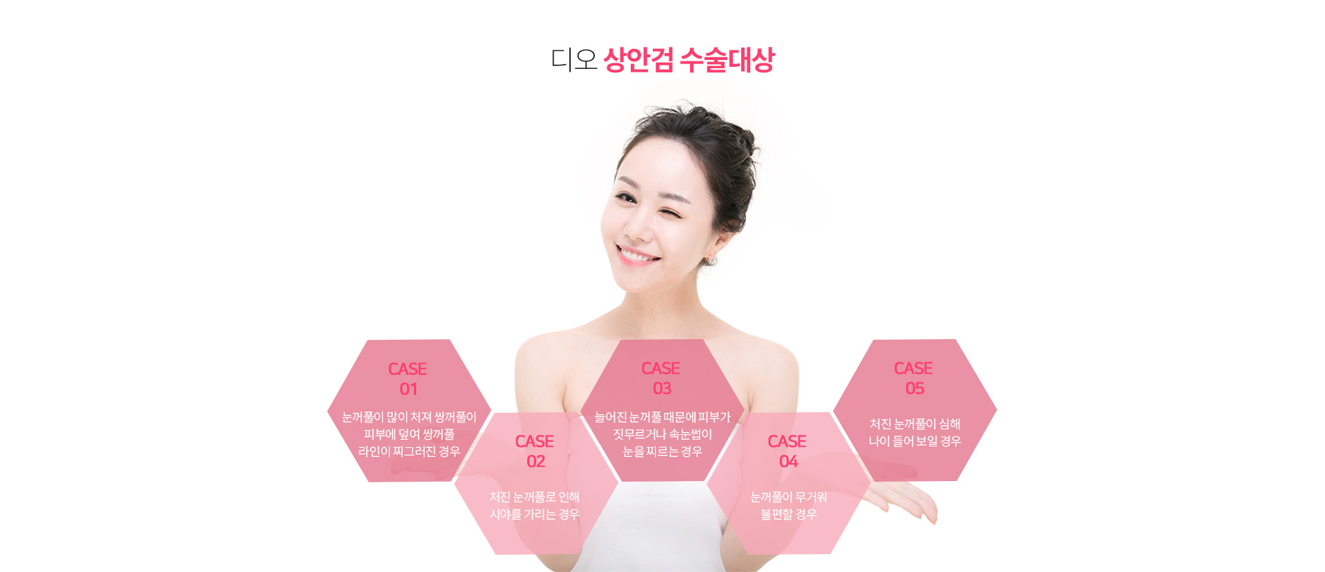 디오 상안검 수술대상 — 눈꺼풀이 많이 처져 쌍꺼풀이 피부에 덮여 라인이 찌그러진 경우, 처진 눈꺼풀로 시야를 가리는 경우, 늘어진 눈꺼풀로 피부가 짓무르거나 속눈썹이 눈을 찌르는 경우, 눈꺼풀이 무거워 불편할 경우, 처진 눈꺼풀이 심해 나이 들어 보일 경우