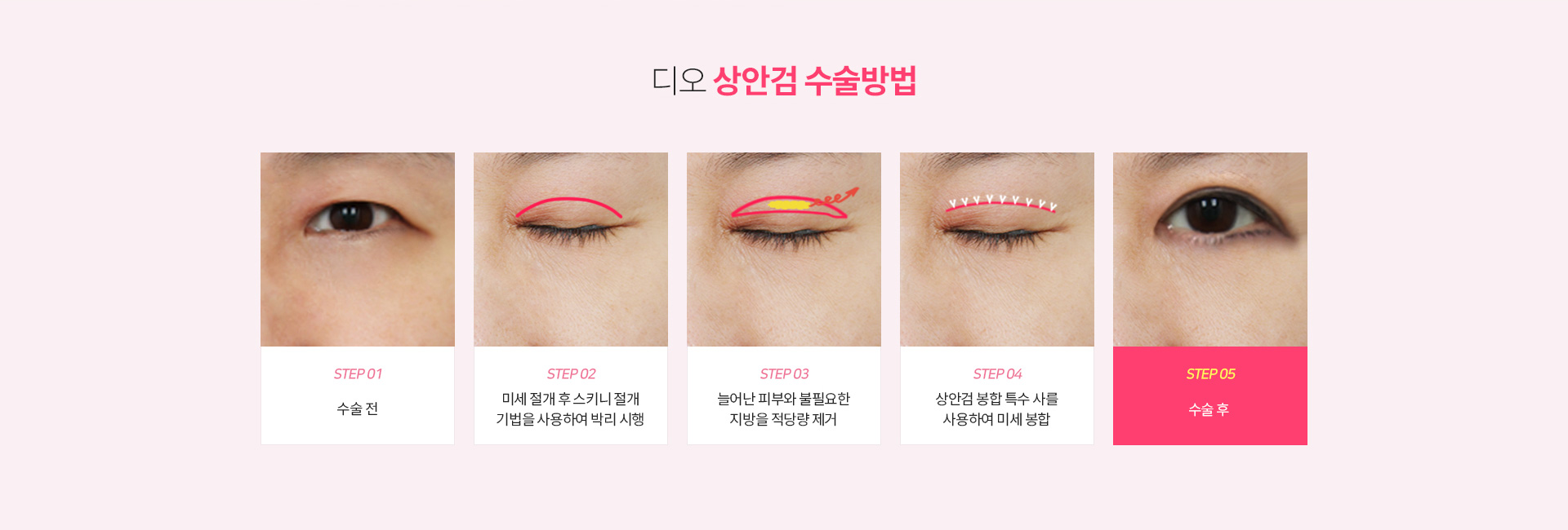 디오 상안검 수술방법 — 수술 전, 미세 절개 후 스키니 절개 기법으로 박리, 늘어난 피부와 불필요한 지방을 적당량 제거, 상안검 봉합 특수 사로 미세 봉합, 수술 후