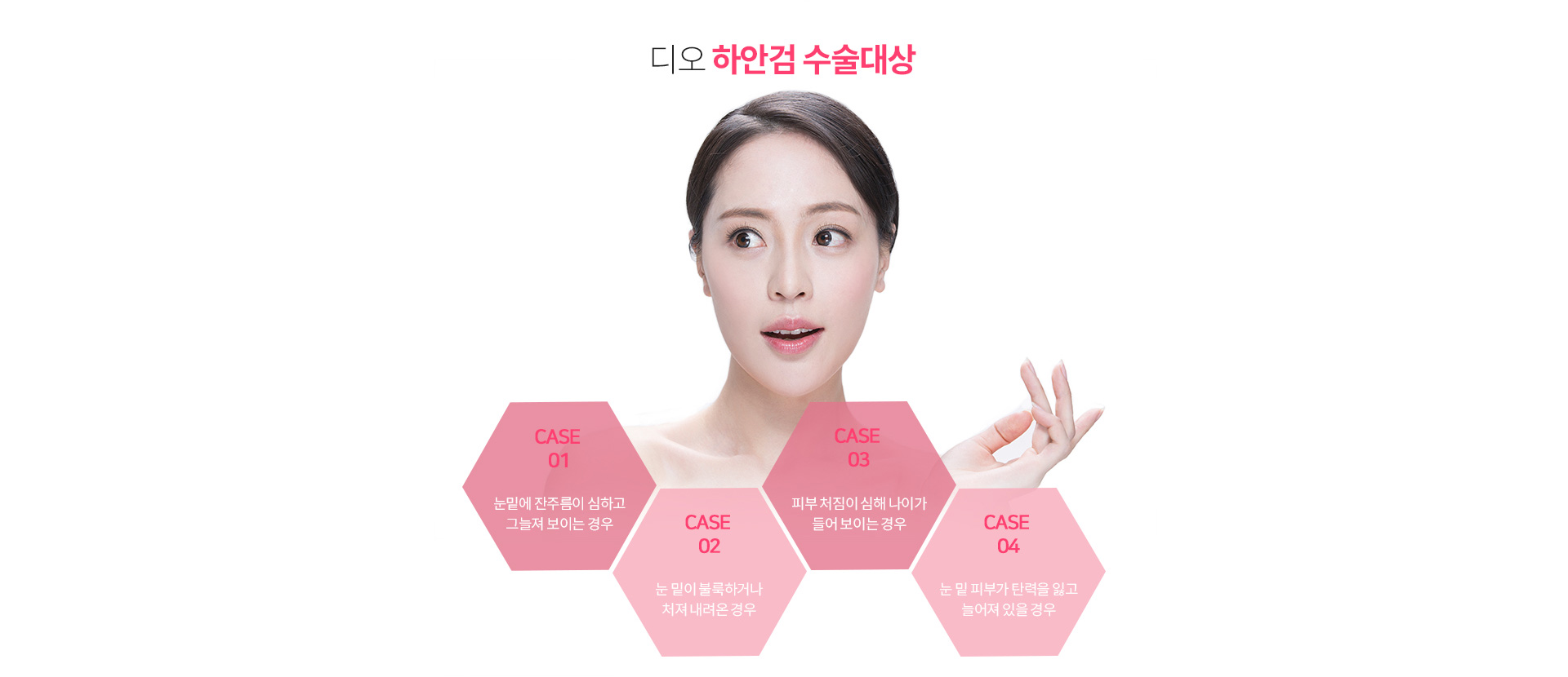 디오 하안검 수술대상 — 눈밑에 잔주름이 심하고 그늘져 보이는 경우, 눈 밑이 볼록하거나 처져 내려온 경우, 피부 처짐이 심해 나이가 들어 보이는 경우, 눈 밑 피부가 탄력을 잃고 늘어져 있을 경우
