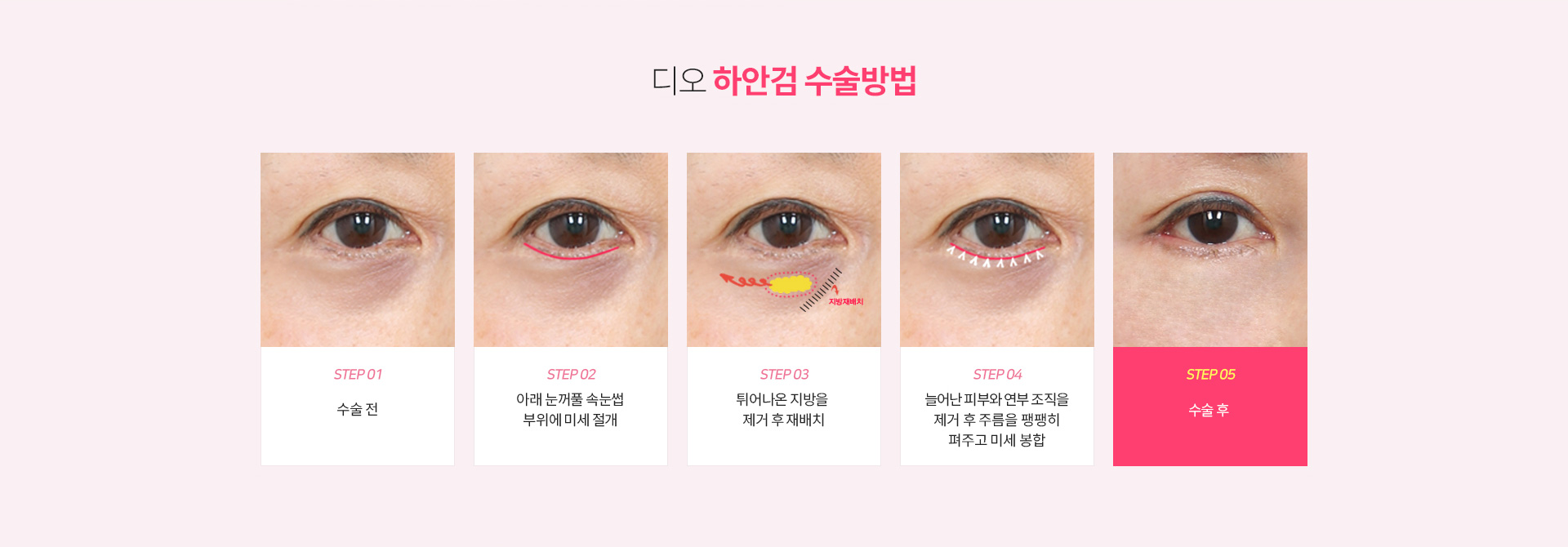 디오 하안검 수술방법 — 수술 전, 아래 눈꺼풀 속눈썹 부위에 미세 절개, 튀어나온 지방을 제거 후 재배치, 늘어난 피부와 연부 조직을 제거 후 주름을 팽팽히 펴주고 미세 봉합, 수술 후