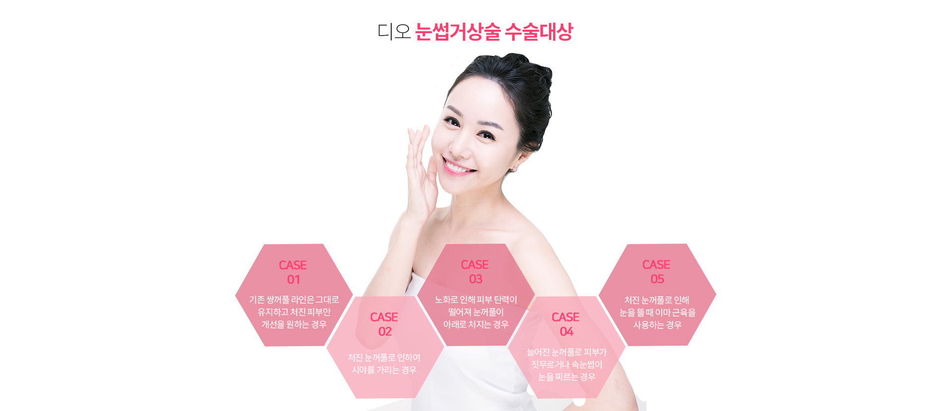 디오 눈썹거상술 수술대상 — 기존 쌍꺼풀 라인은 그대로 유지하고 처진 피부만 개선을 원하는 경우, 처진 눈꺼풀로 시야를 가리는 경우, 노화로 피부 탄력이 떨어져 눈꺼풀이 아래로 처지는 경우, 늘어진 눈꺼풀로 피부가 짓무르거나 속눈썹이 눈을 찌르는 경우, 처진 눈꺼풀로 눈을 뜰 때 이마 근육을 사용하는 경우