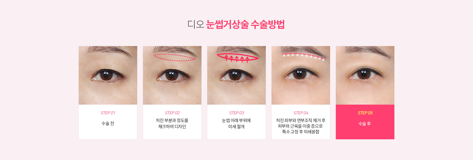 디오 눈썹거상술 수술방법 — 수술 전, 처진 부분과 정도를 체크하여 디자인, 눈썹 아래 부위에 미세 절개, 처진 피부와 연부조직 제거 후 피부와 근육을 이중 층으로 특수 고정 후 미세봉합, 수술 후