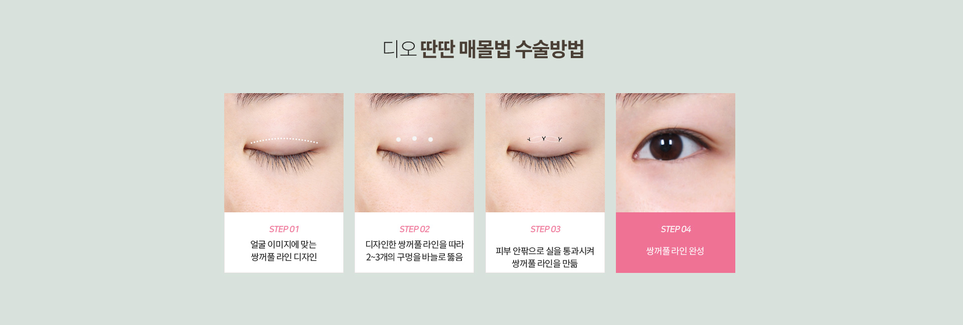 디오 딴딴 매몰법 수술방법 — 쌍꺼풀 라인 디자인, 2~3개 구멍, 실 통과, 쌍꺼풀 라인 완성