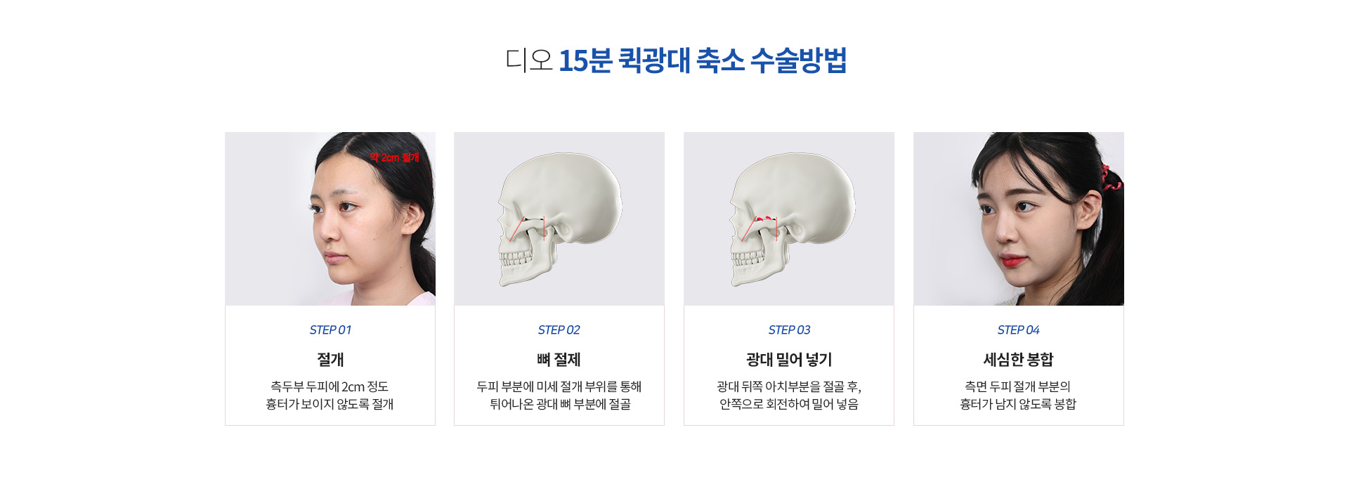15분 퀵광대 축소 수술방법