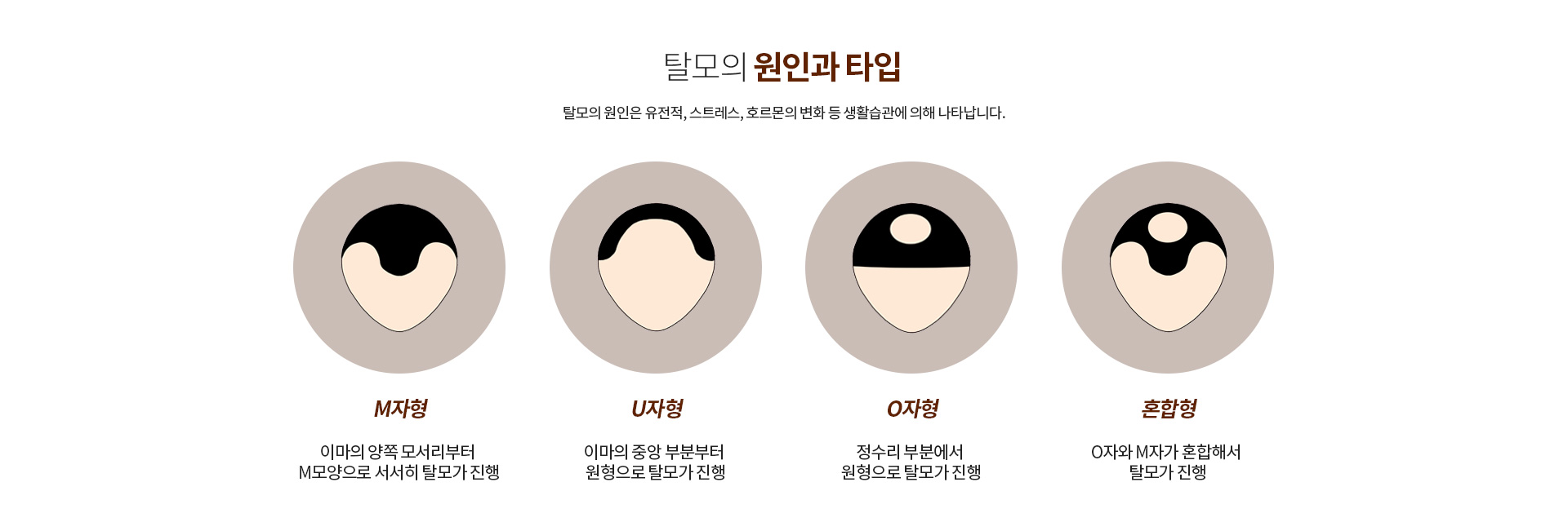 탈모의 원인과 타입