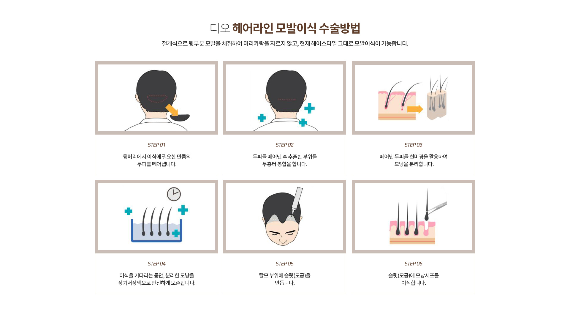 헤어라인 모발이식 수술방법