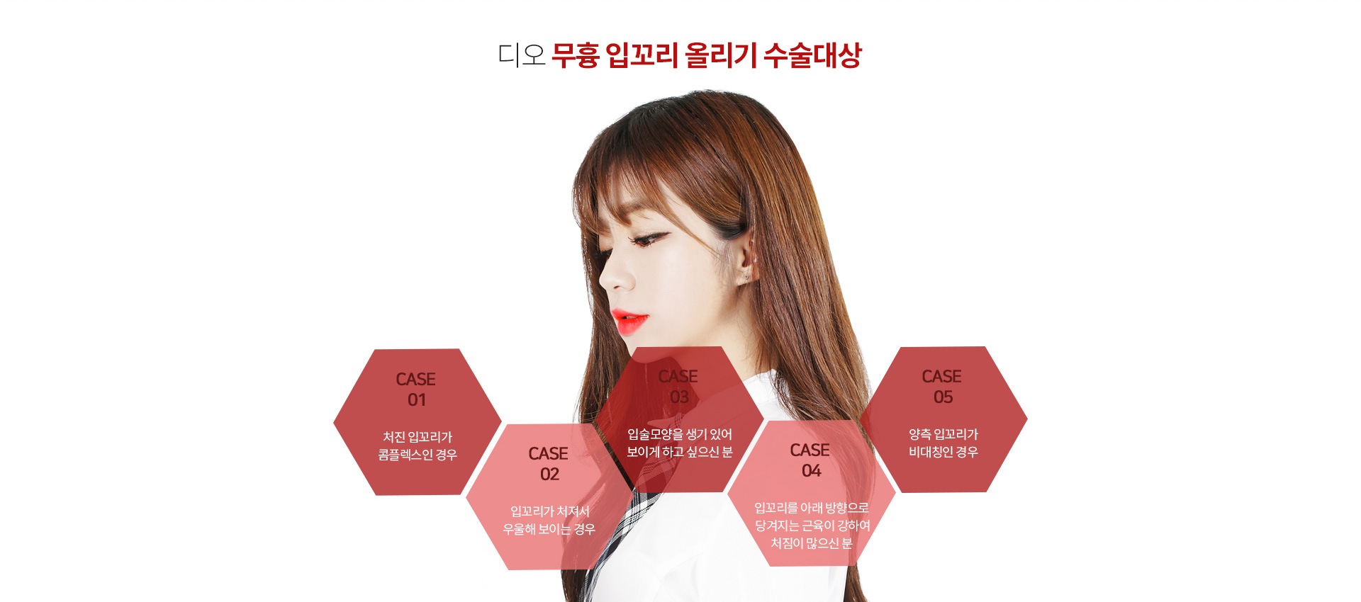 디오 무흉 입꼬리 올리기 수술대상 — 처진 입꼬리가 콤플렉스인 경우, 입꼬리가 처져서 우울해 보이는 경우, 입술모양을 생기 있어 보이게 하고 싶은 분, 입꼬리를 아래 방향으로 당겨지는 근육이 강하여 처짐이 많으신 분, 양측 입꼬리가 비대칭인 경우