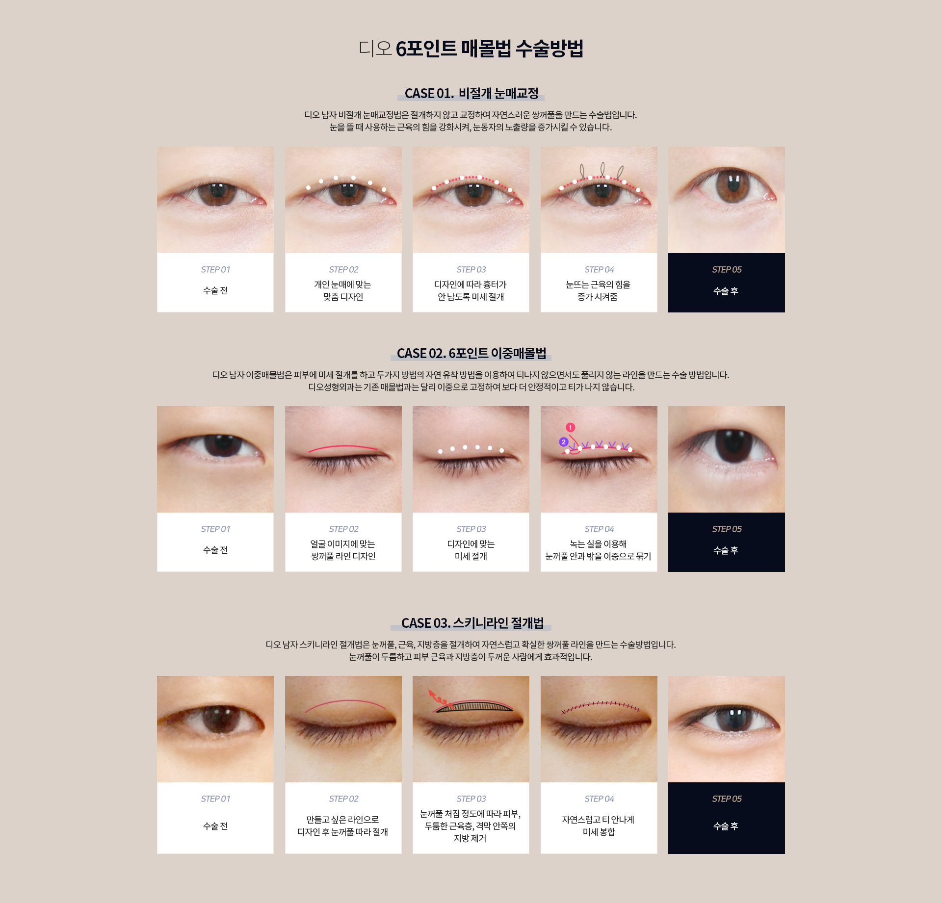 디오 6포인트 매몰법 수술방법 — 비절개 눈매교정은 절개하지 않고 눈뜨는 근육의 힘을 강화, 6포인트 이중매몰법은 미세 절개 후 녹는 실로 눈꺼풀 안과 밖을 이중으로 묶어 티나지 않으면서 풀리지 않는 라인, 스키니라인 절개법은 눈꺼풀·근육·지방층을 절개해 확실한 라인