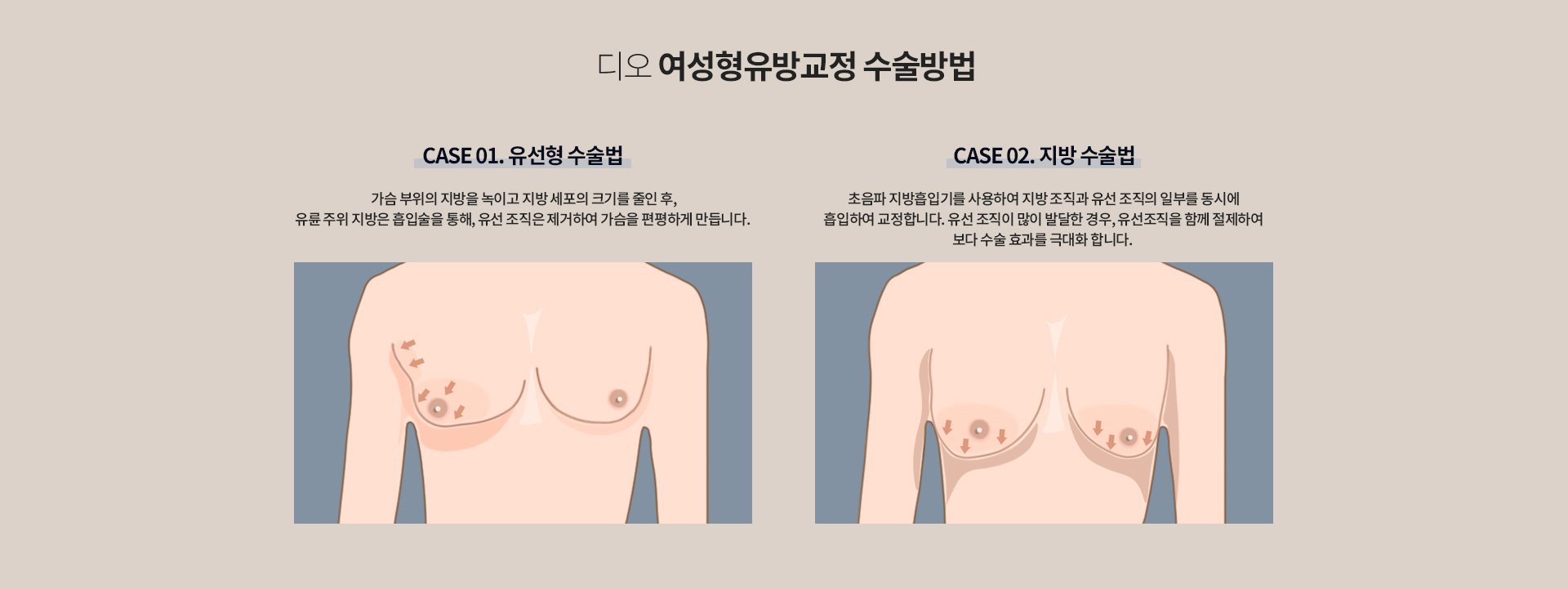 디오 여성형유방교정 수술방법 — 유선형 수술법은 가슴 부위의 지방을 녹이고 지방 세포의 크기를 줄인 후 유륜 주위 지방은 흡입술로, 유선 조직은 제거하여 가슴을 편평하게. 지방 수술법은 초음파 지방흡입기로 지방 조직과 유선 조직의 일부를 동시에 흡입하여 교정