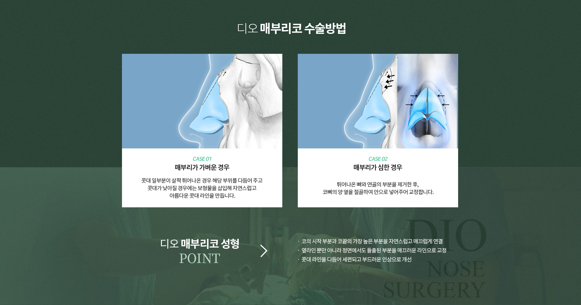 메부리코성형수술방법