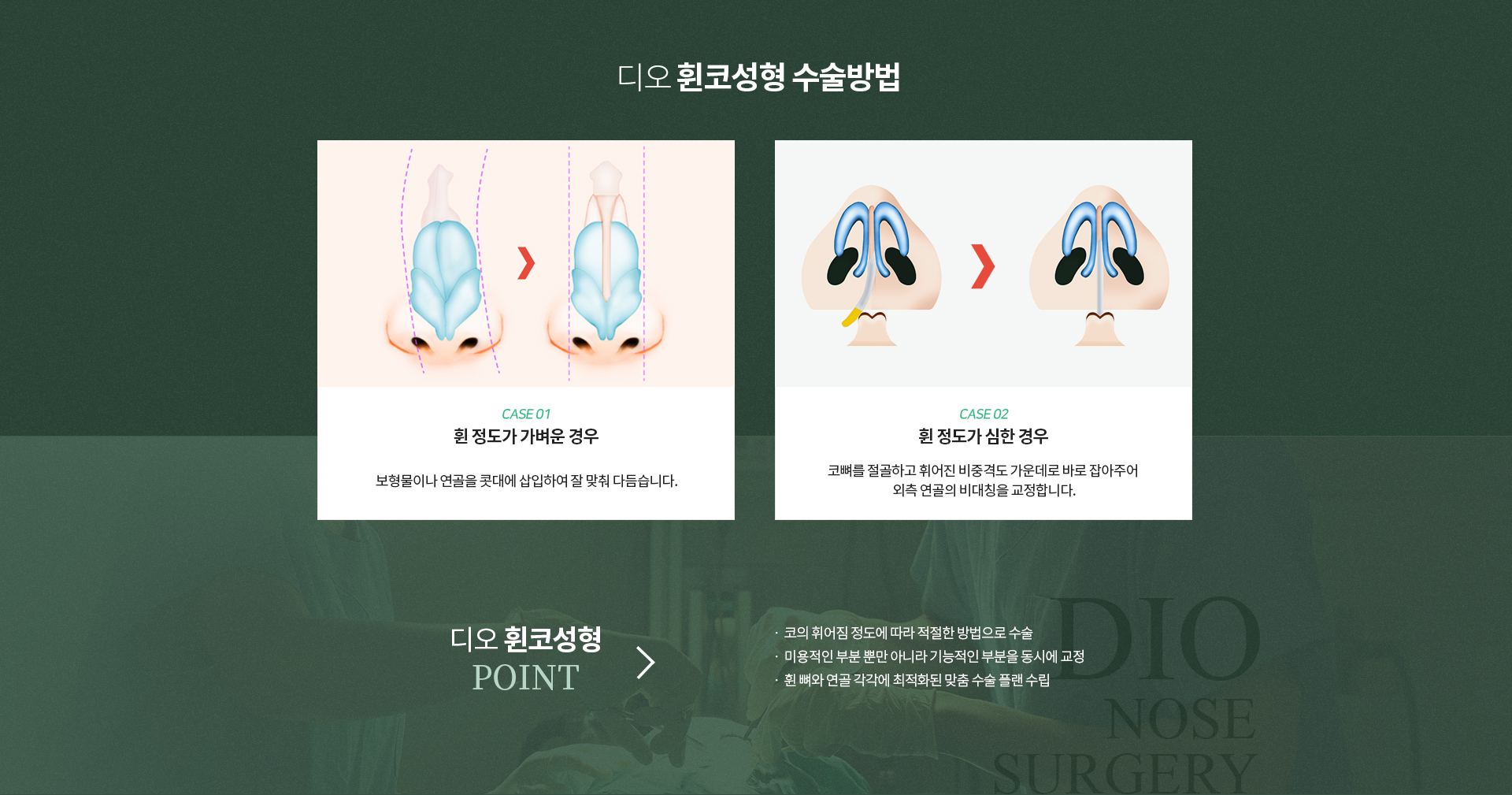 휜코성형수술방법