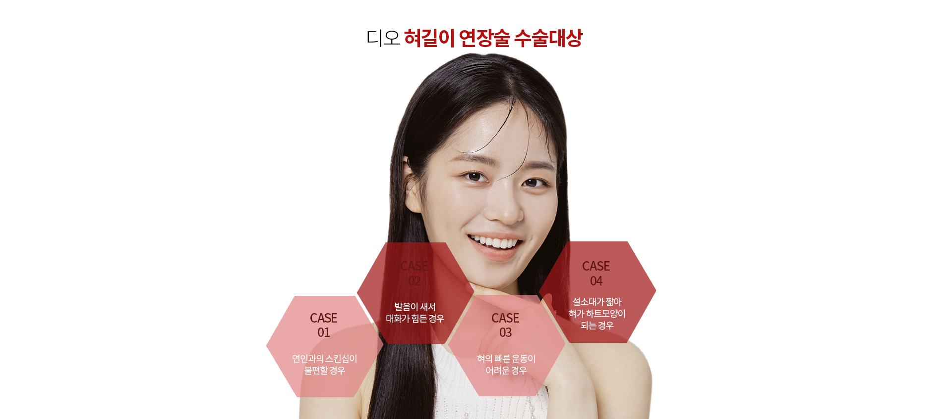 디오 혀길이 연장술 수술대상 — 연인과의 스킨십이 불편할 경우, 발음이 새서 대화가 힘든 경우, 혀의 빠른 운동이 어려운 경우, 설소대가 짧아 혀가 하트모양이 되는 경우