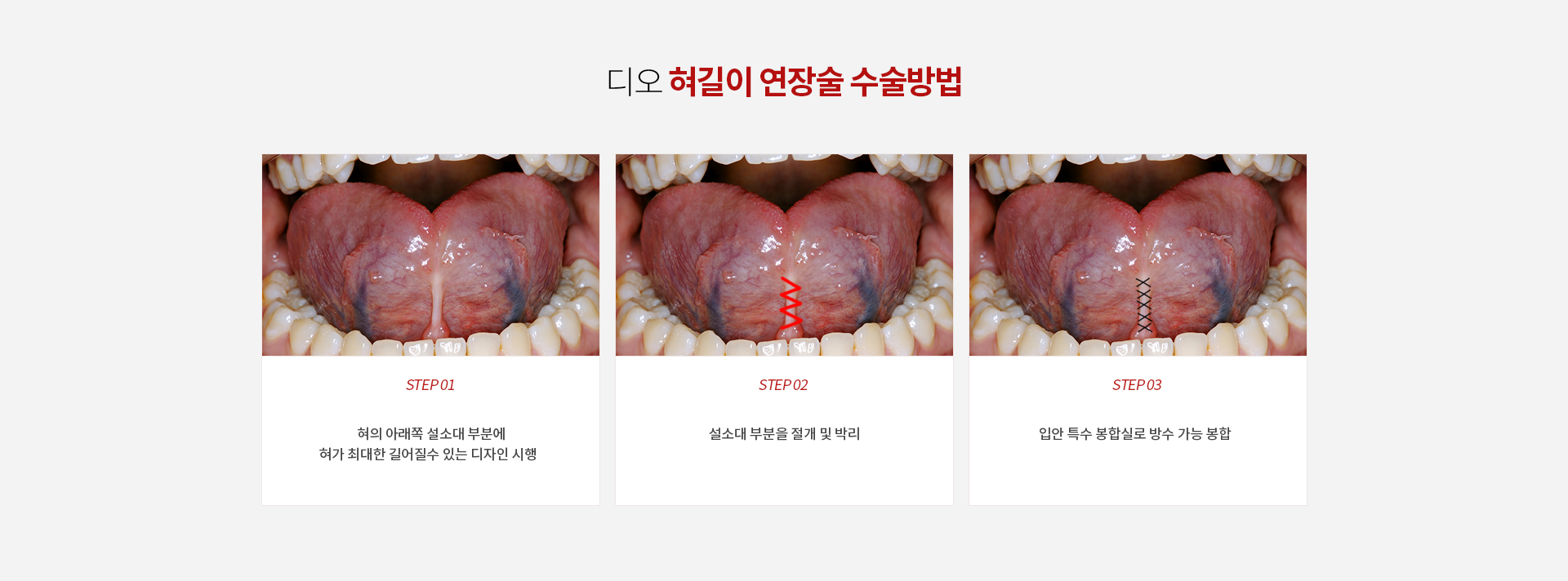 디오 혀길이 연장술 수술방법 — 혀의 아래쪽 설소대 부분에 혀가 최대한 길어질 수 있는 디자인 시행, 설소대 부분을 절개 및 박리, 입안 특수 봉합실로 방수 가능 봉합